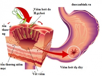 Bệnh viêm loét dạ dày tá tràng và cách phòng ngừa